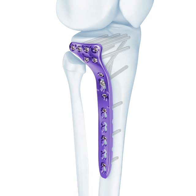 Placa de bloqueo de tibia proximal de VA