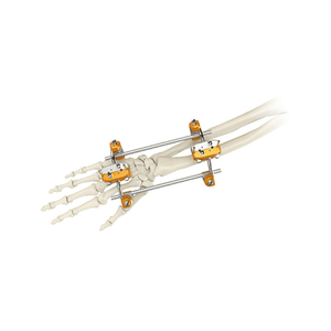Fijador externo de Uina & Radius