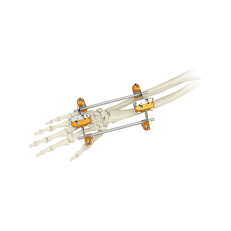 Fijador externo de Uina & Radius