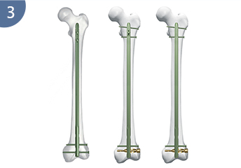 Experto R/Afn.Clavo femoral retrógrado/anterógrado