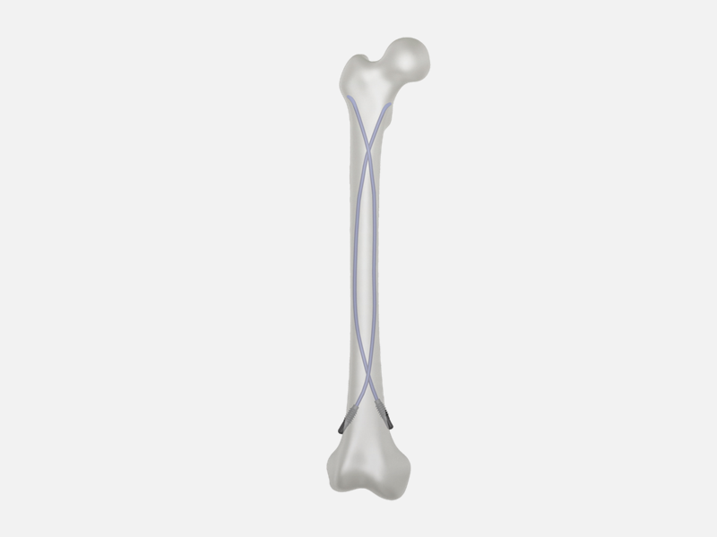 Clavo elástico de titanio: una solución innovadora para la fijación de fracturas