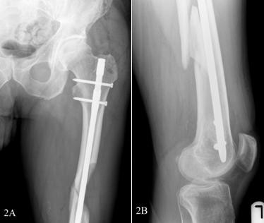 A-Vista anteroposterior-del-fémur-proximal-con-el-clavo-intramedular-in-situ-B