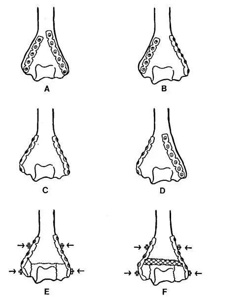 Fracturas de húmero distal