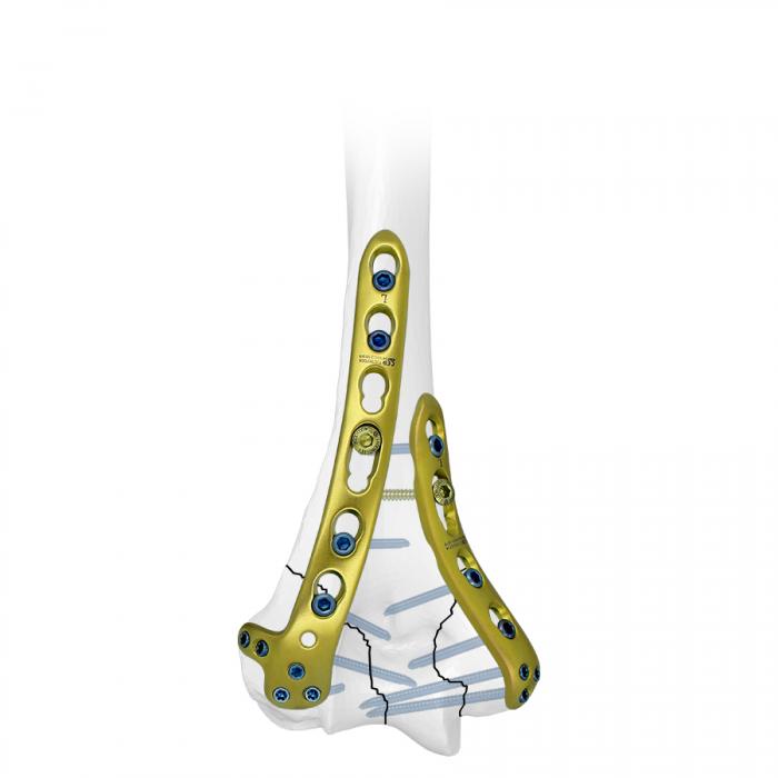 ¿Cómo reparar fracturas de húmero distal usando placas?