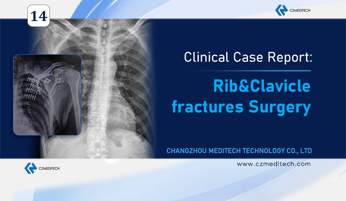 Estudio de caso: Fijación de fracturas de costillas y clavículas con estabilización de la pared torácica en México