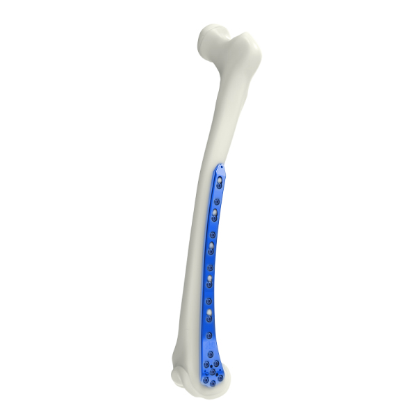 Placa de bloqueo femoral distal