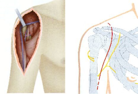 Fractura humeral proximal