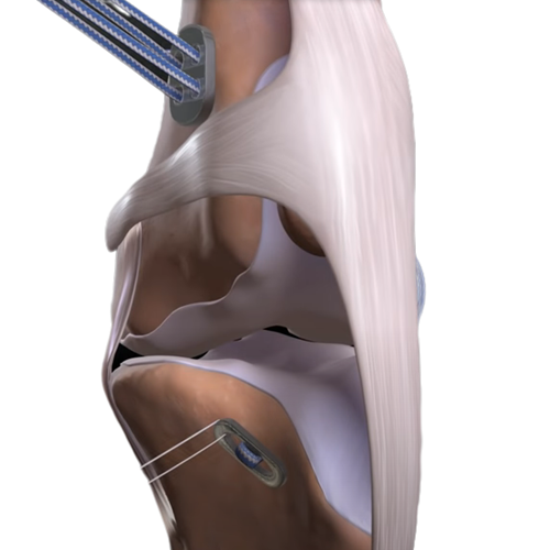 Sistema de ligamentos artificiales