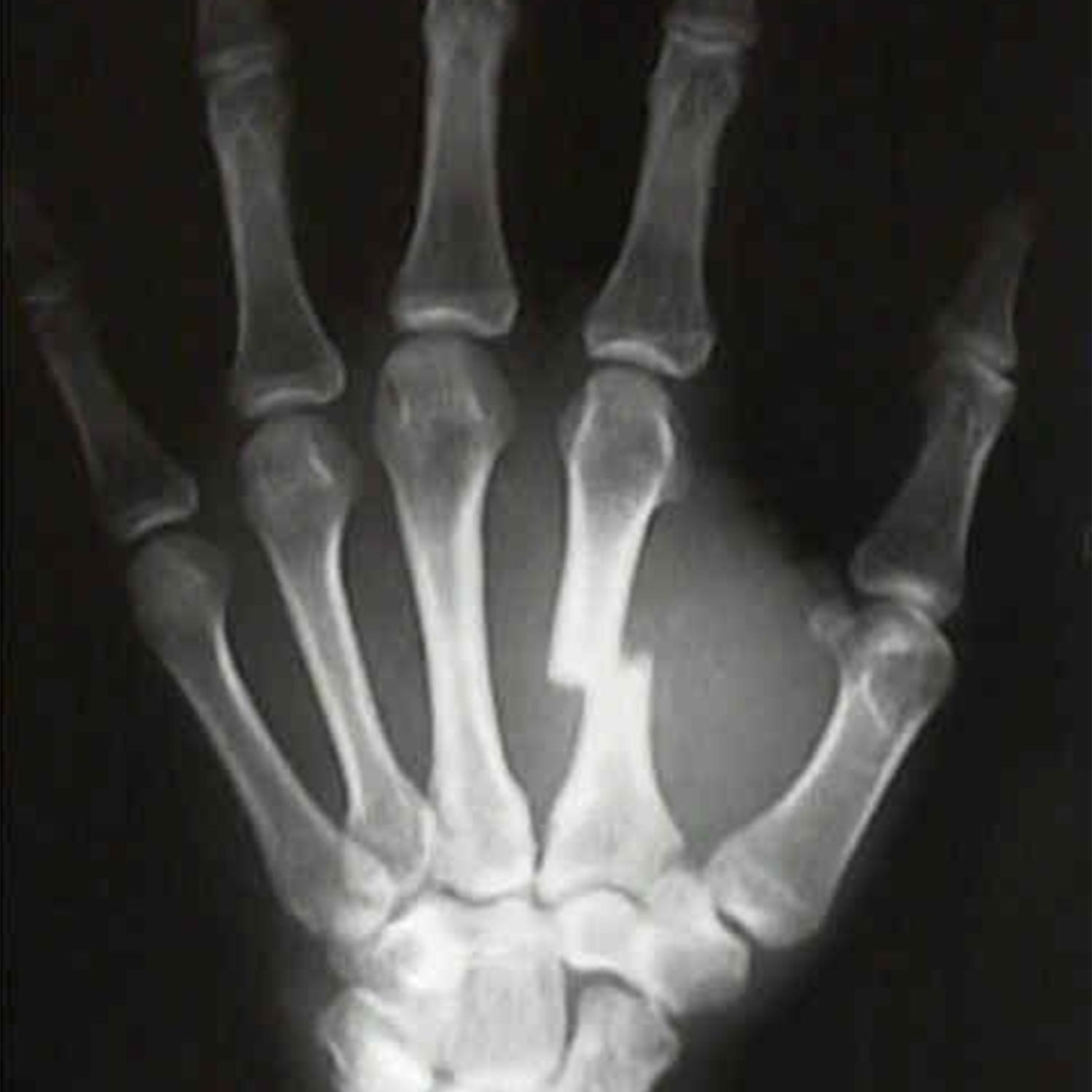 ¿Sabes cómo arreglar una fractura de metacarpiano?