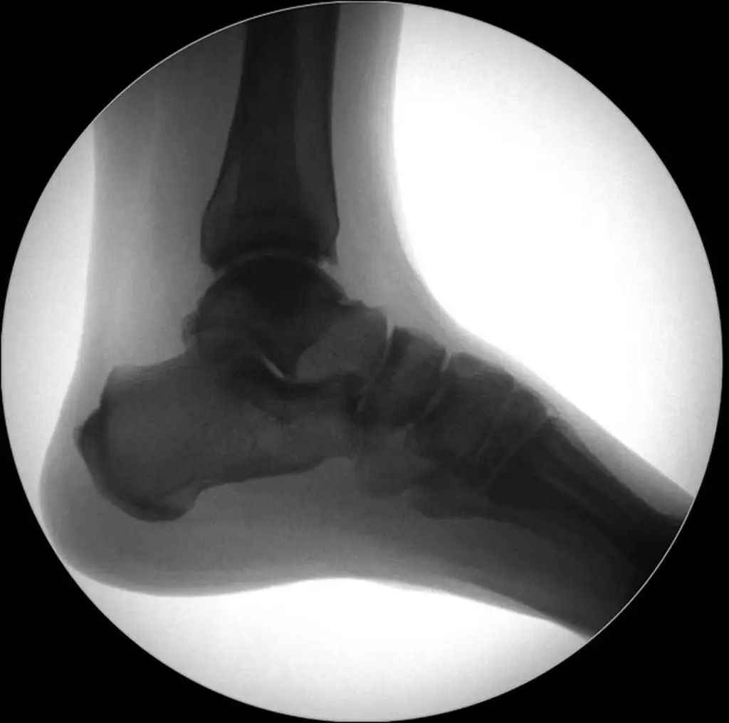 Cirugía de reducción cerrada para fracturas de extremidades inferiores.