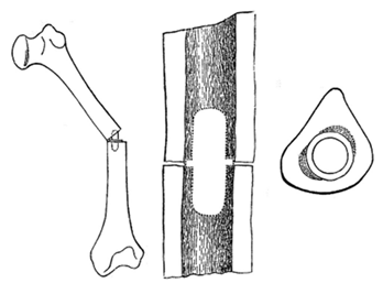 clavo intramedular