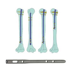 Uña intramedular humeral (tipo de cuchilla)