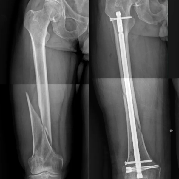 Dfn fémur distal uña intramedular 