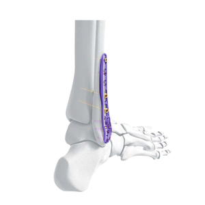 Placa de bloqueo de peroné lateral distal