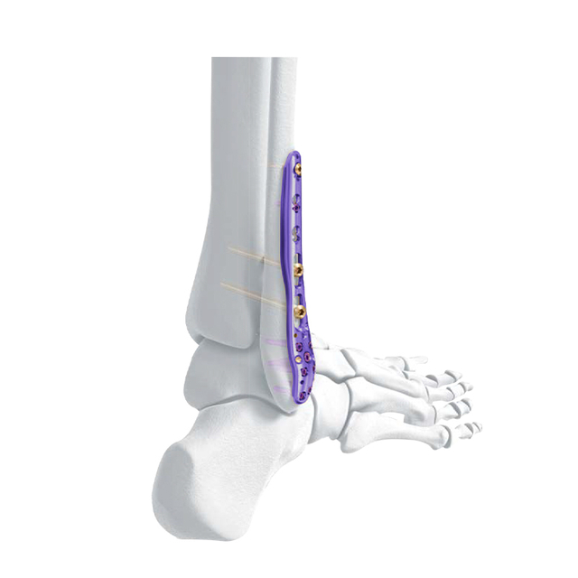Placa de bloqueo de peroné lateral distal