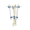 Tibia proximal fijador externo