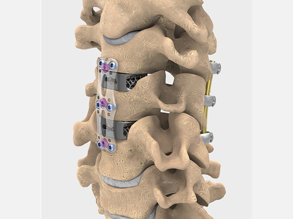 ¿Qué son los implantes cervicales?