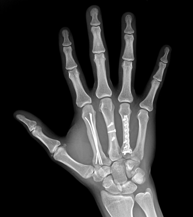 ¿Qué es una fractura metacarpiana?