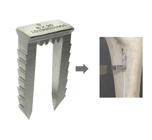 Grapa de ligamento