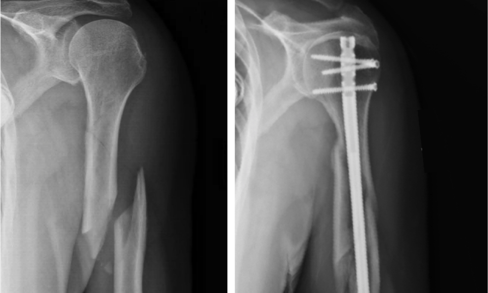 Tratamiento quirúrgico de fracturas de vástago humeral y puntos técnicos