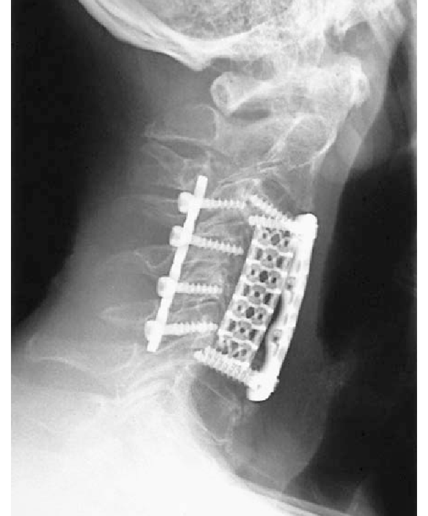jaula de la columna vertebral
