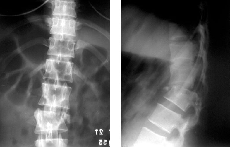 fractura de columna