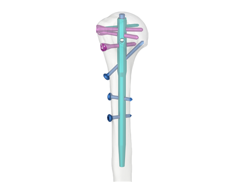 Clavo intramedular humeral Multi-Lock: Avances en el tratamiento de fracturas de hombro