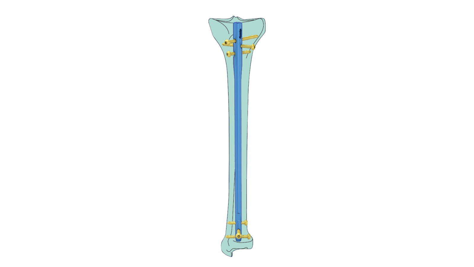 Clavo intramedular tibial suprapatelar SURA™