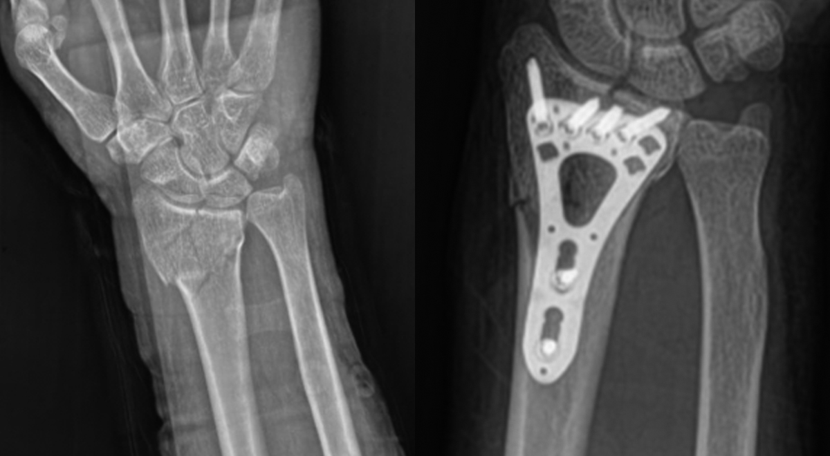 Cirugía exitosa de fractura de radio distal en México utilizando un VA Placa de bloqueo