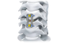 Placa cervical anterior NovaFix-I