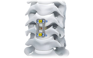 Placa cervical anterior NovaFix-I