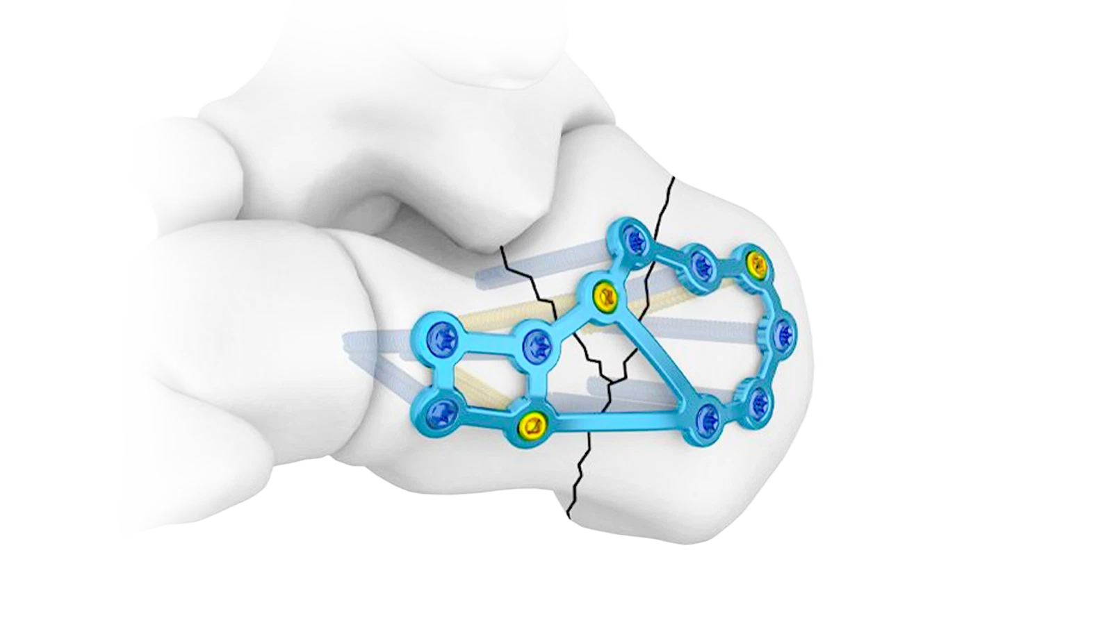 Foot and Ankle locking plate system