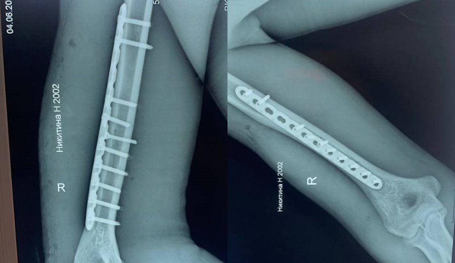 postoperatoria de humeral derecho placa de bloqueo