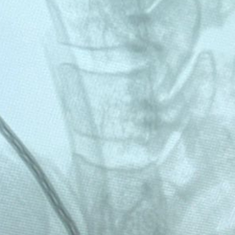 Radiograf&iacute;a lateral de columna cervical preoperatoria
