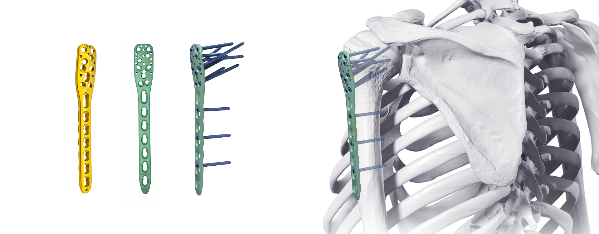 Aplicaci&oacute;n quir&uacute;rgica de fijaci&oacute;n con placa de bloqueo del h&uacute;mero proximal.jpg