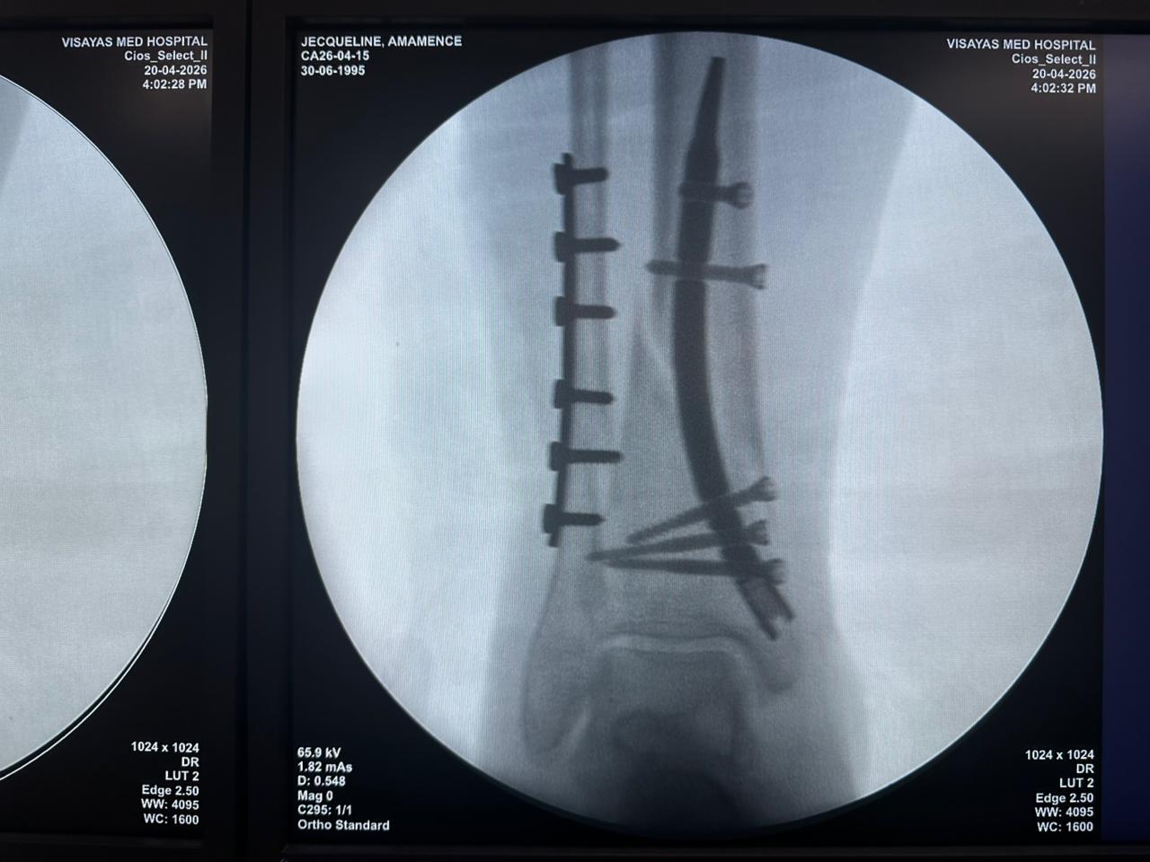 clavo-tibial-distal-fluoroscopia-intraoperatoria-CZMEDITECH (4)