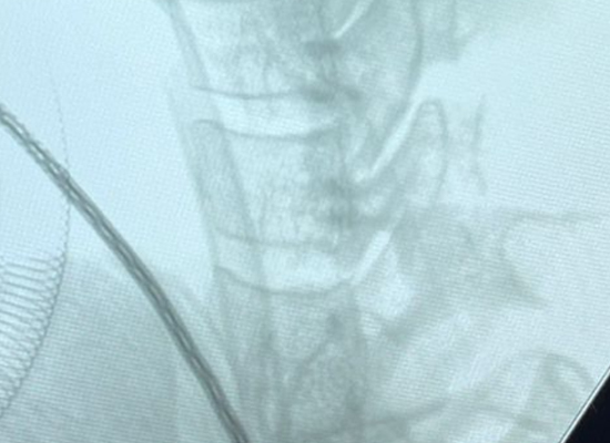 Radiograf&iacute;a cervical lateral preoperatoria que muestra el nivel objetivo para la colocaci&oacute;n de la jaula Mexican Uni-C