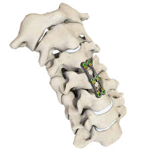 Placa cervical anterior ARIES-III