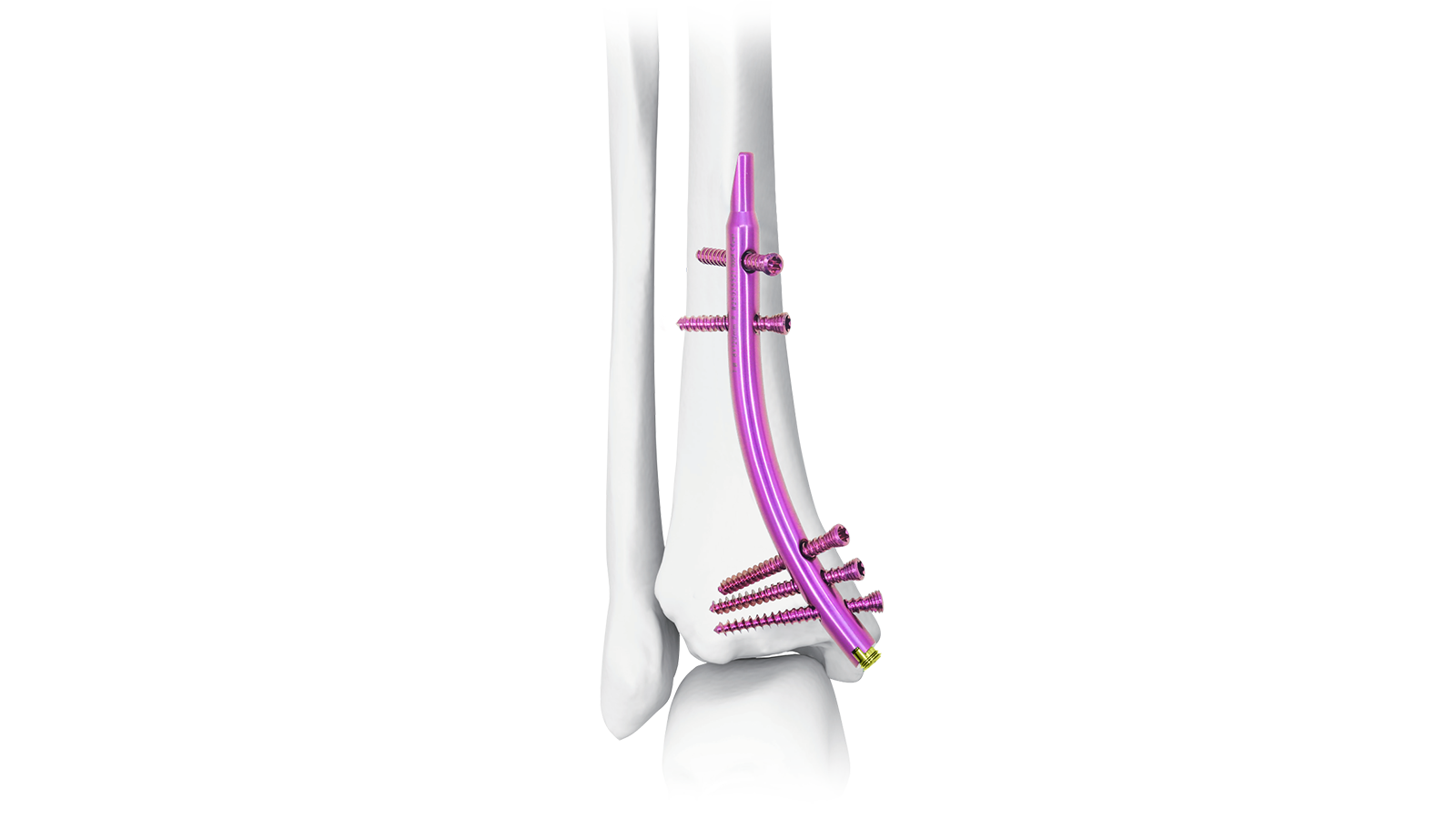 Tibia sistema de clavo intramedular