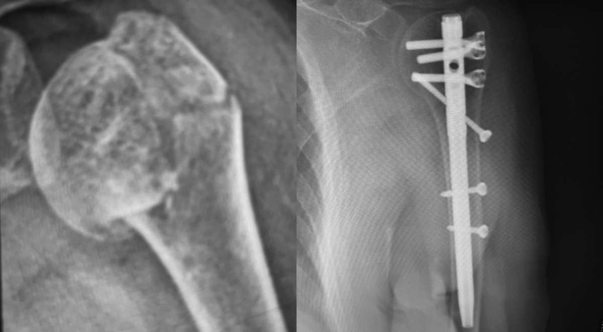 Fractura de cabeza humeral tratada con Multi-lock Humeral Clavo intramedular