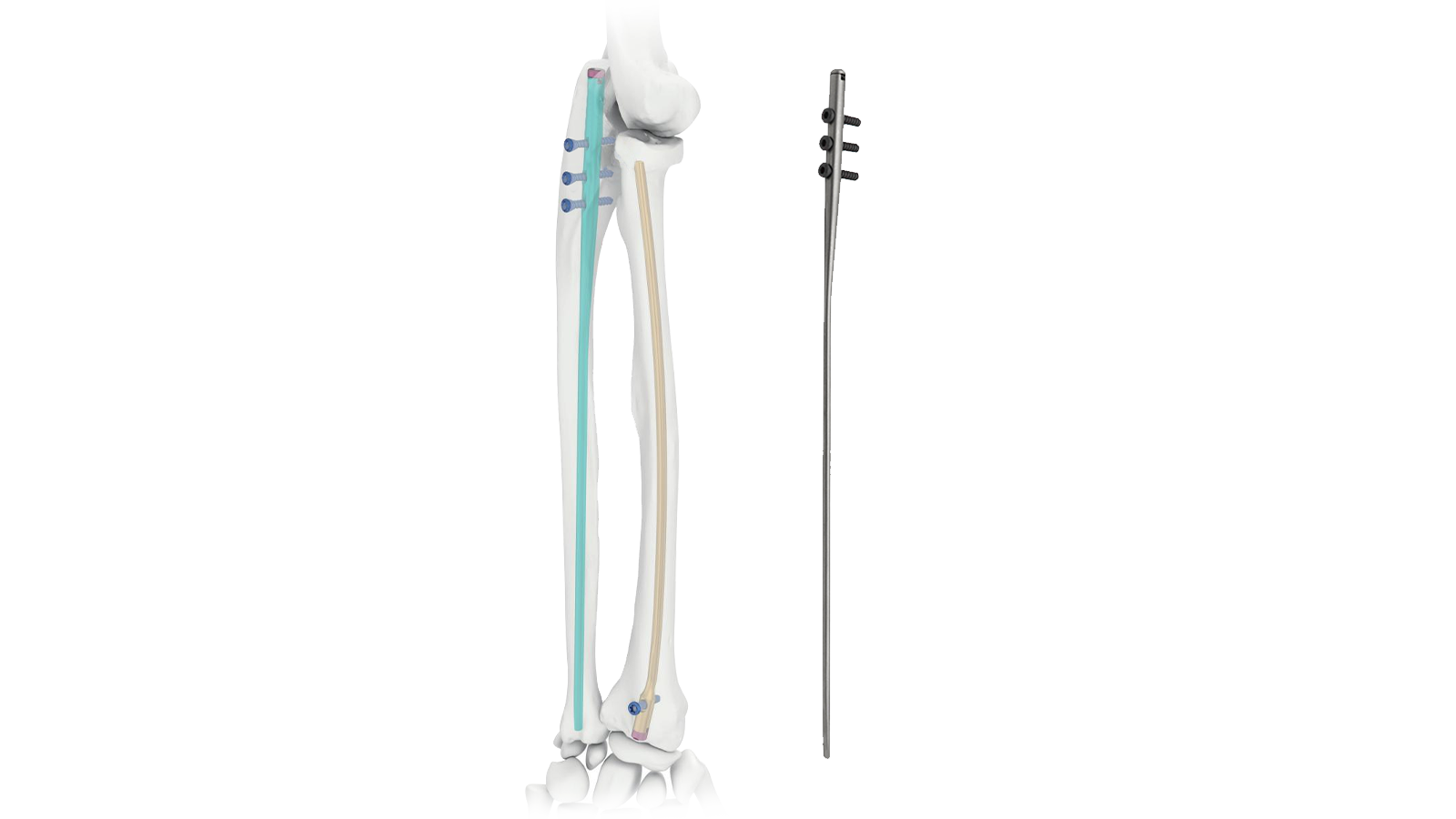 Clavo intramedular para cúbito ULIX™