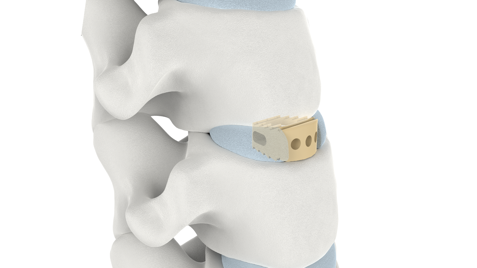 FUSA-II™ Sistema de fusión intersomática cervical de PEEK