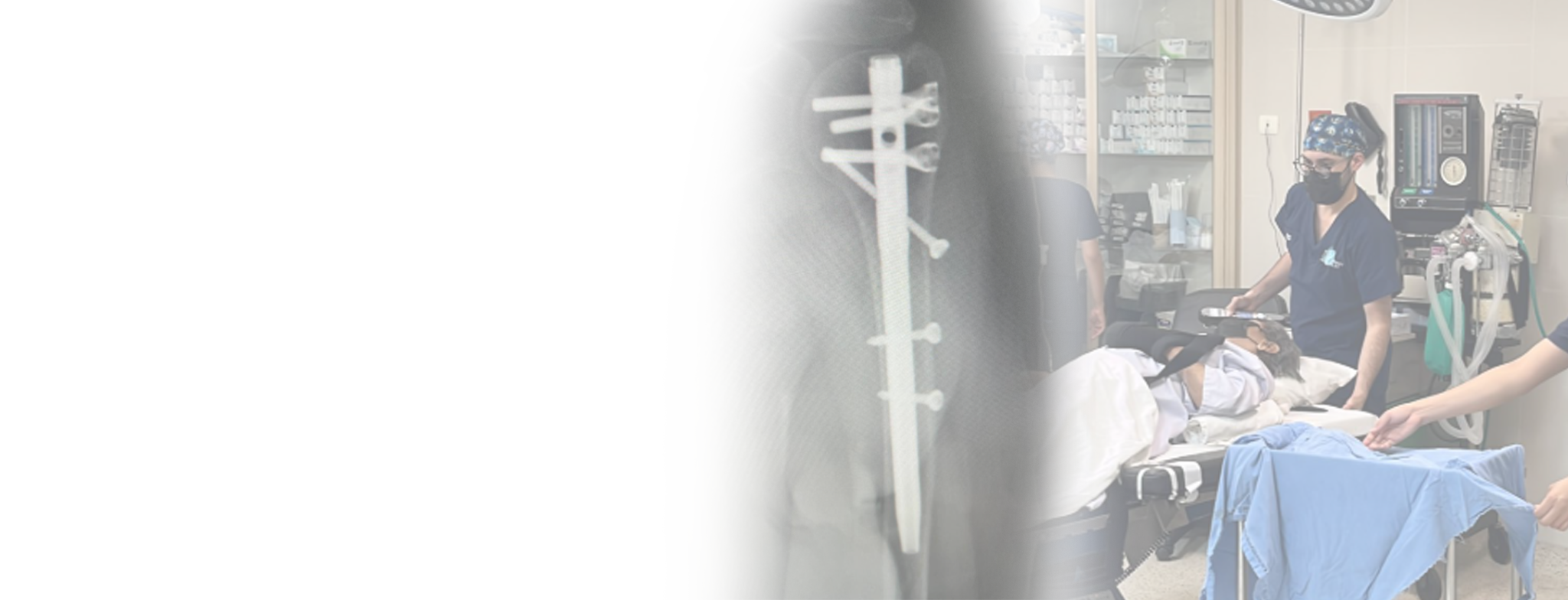 Fijaci&oacute;n de fractura de cabeza humeral con clavo intramedular humeral en el quir&oacute;fano 