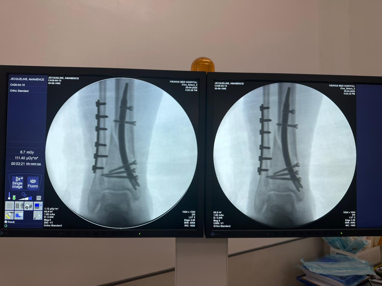 caso-de-fijaci&oacute;n-de-tibia-distal-peron&eacute;-CZMEDITECH
