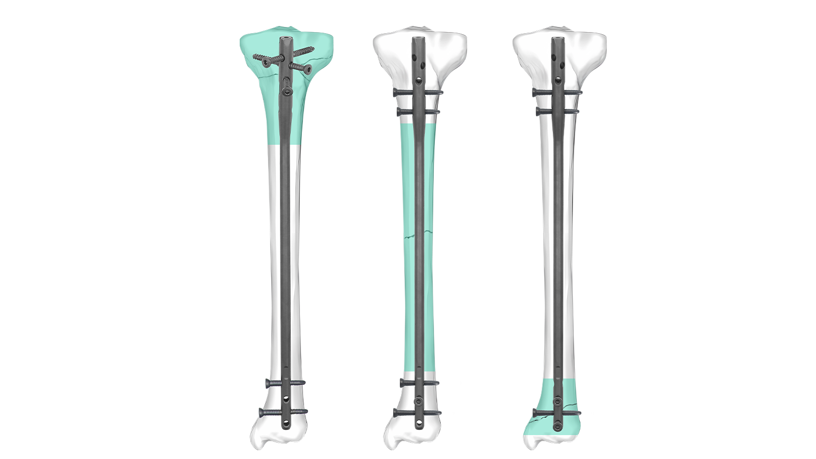 Clavo intramedular tibial Expert TIVO™