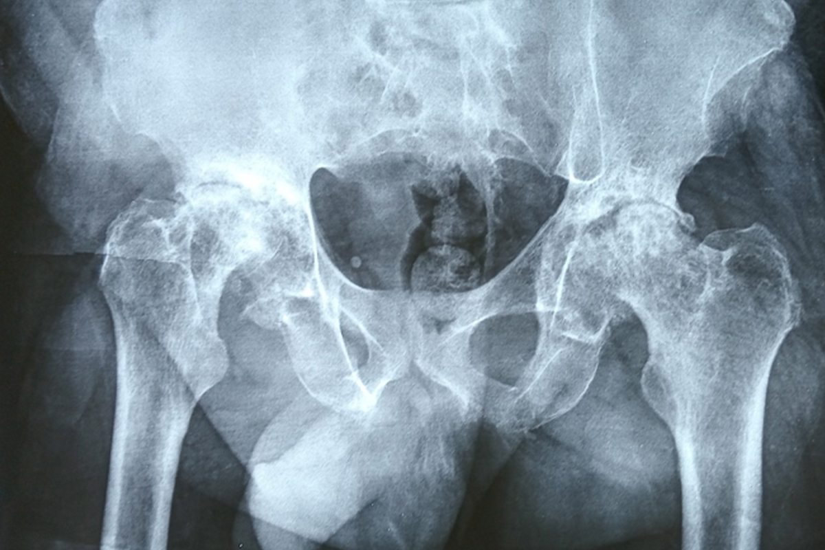 Radiograf&iacute;a p&eacute;lvica preoperatoria antes de la artroplastia total de cadera derecha 