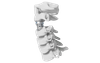 Jaula lumbar expandible Stryker