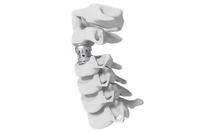 Jaula lumbar expandible Stryker