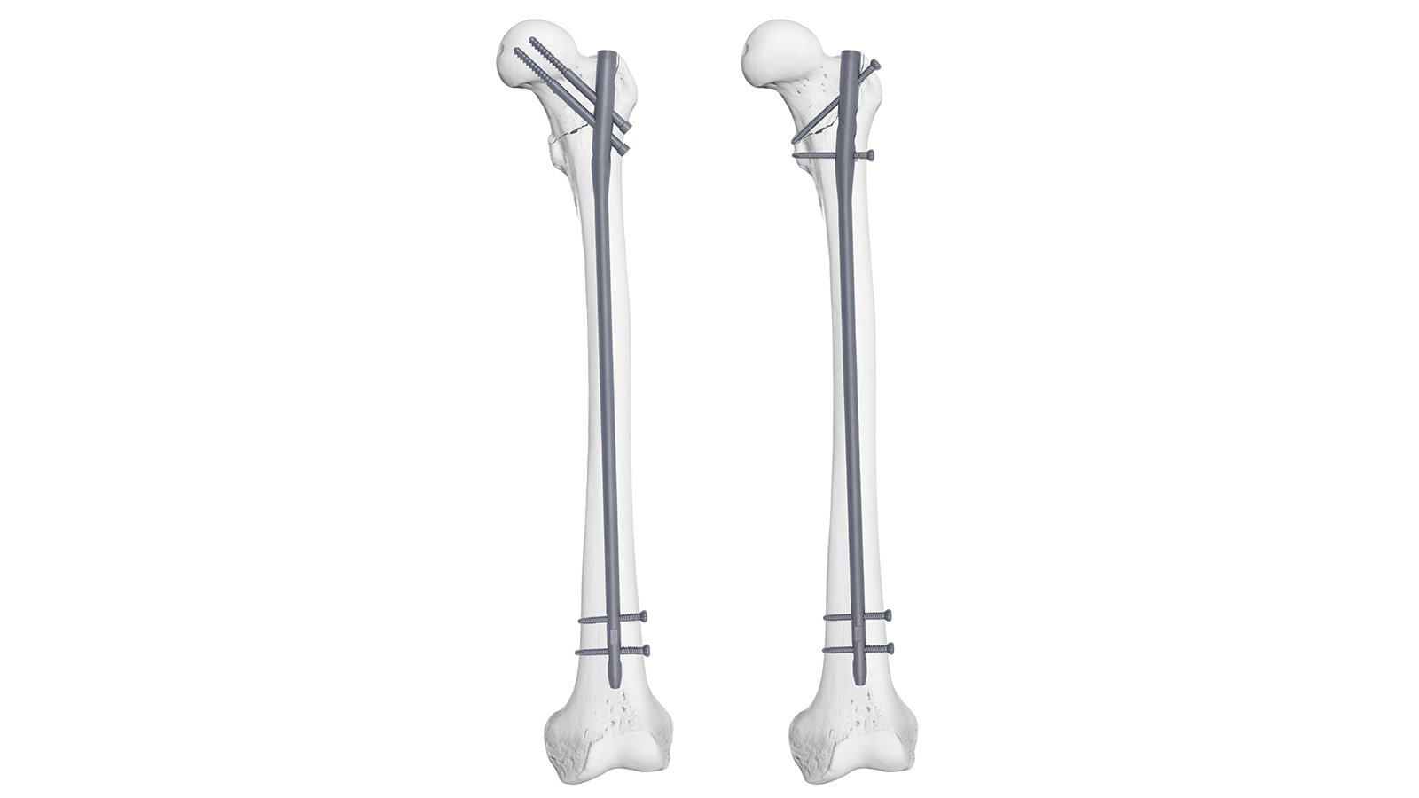 Clavo intramedular femoral Expert RIVO™