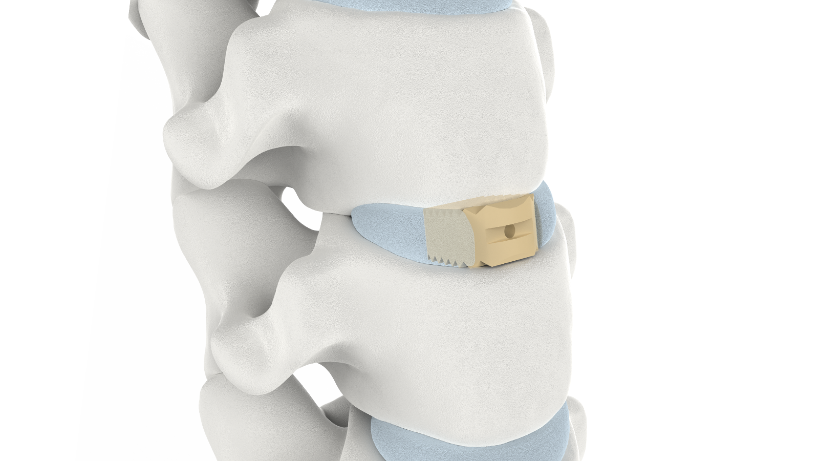 FUSA-I™ Sistema de fusión intersomática cervical de PEEK